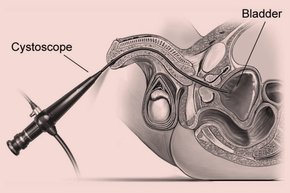 Cystoscopy procedure showing a cystoscope inserted into the bladder to examine the urinary tract, highlighting the bladder anatomy for medical education and information on diagnostic procedures.