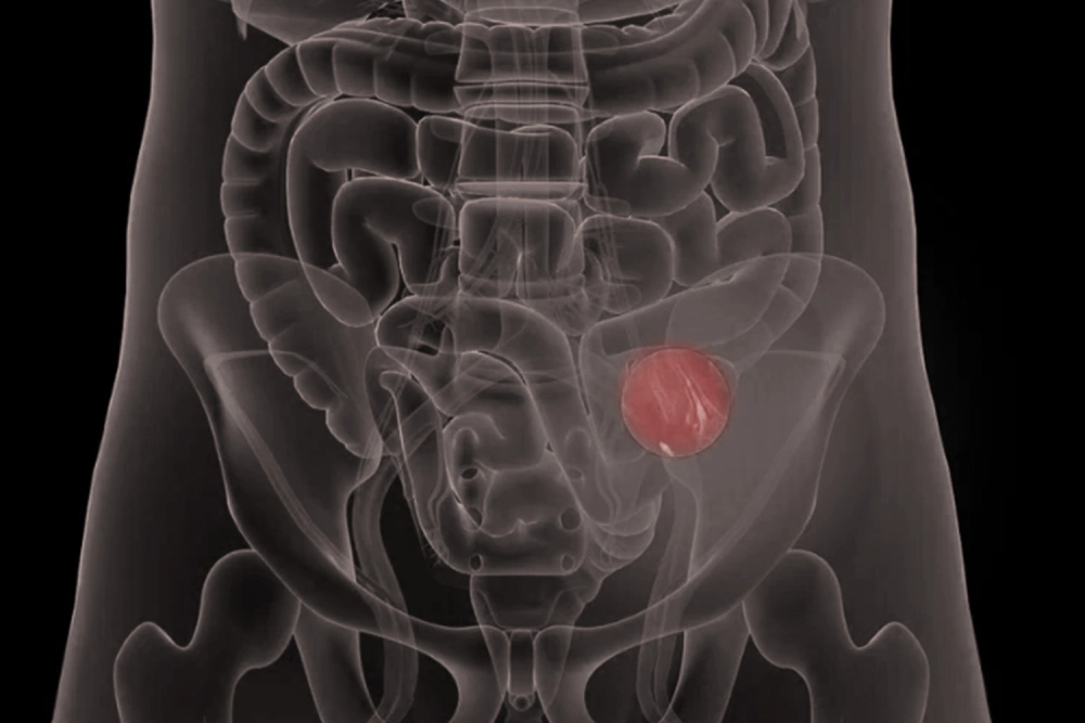 Medical illustration of human torso showing a highlighted tumor in the bladder area
