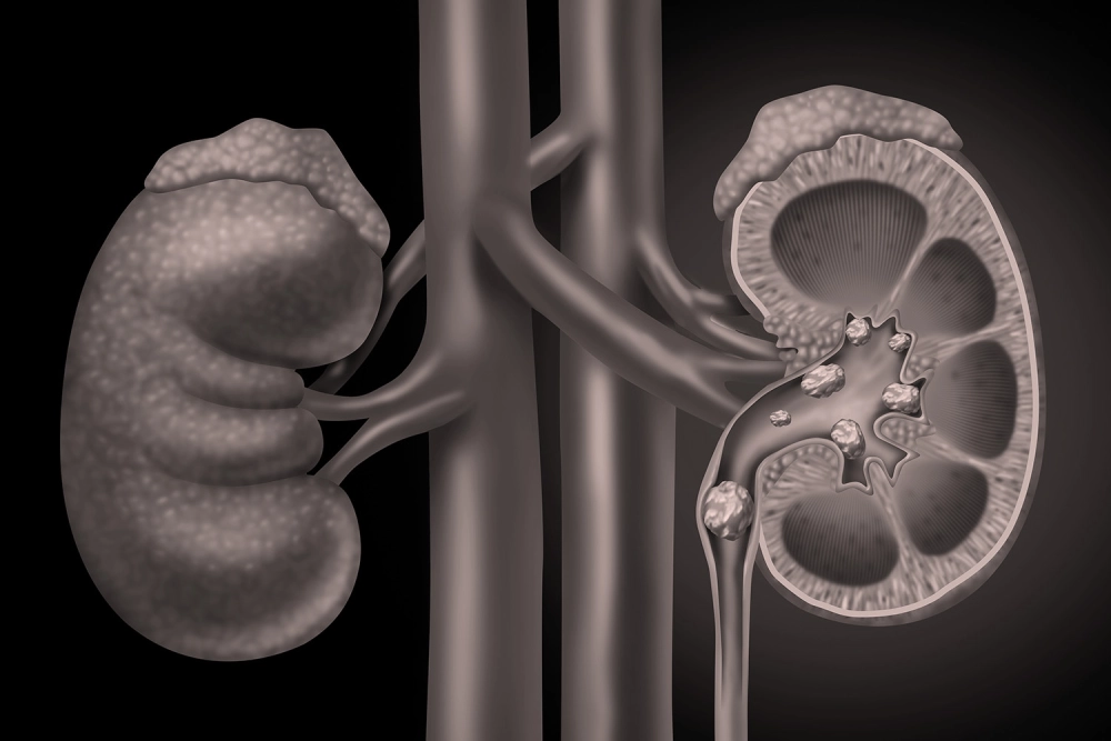 3D medical illustration showing kidney stones forming inside the renal structure, highlighting urinary tract blockage and nephrology issues.