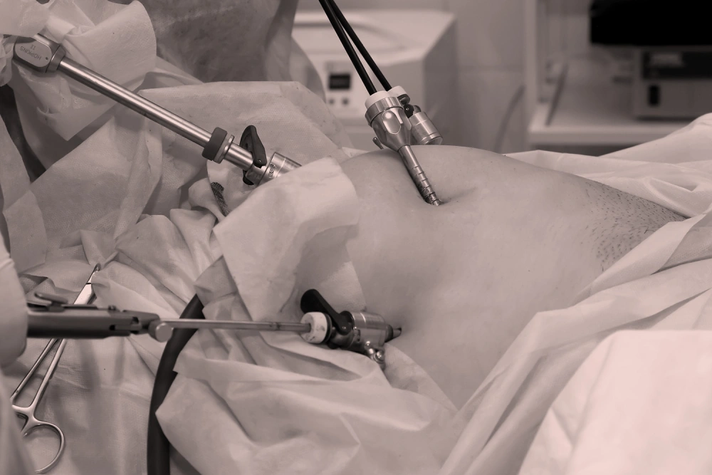 Close-up view of laparoscopic abdominal surgery with trocars and instruments inserted through small incisions in the patient's abdomen.