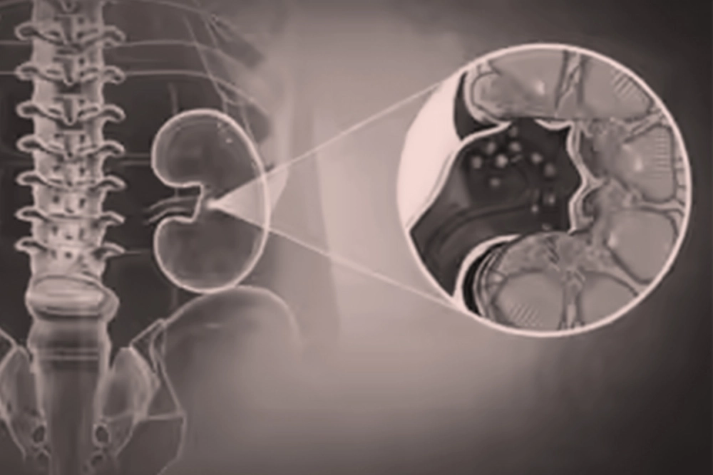 X-ray style scan of human kidney showing multiple kidney stones inside, with close-up view of affected internal tissues and renal calyces.
